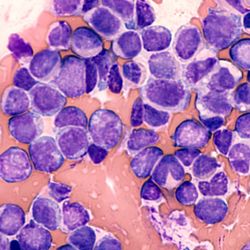 Blood cancer cells