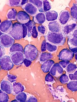 Blood cancer cells