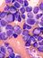 Blood cancer cells