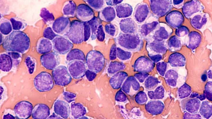 Blood cancer cells