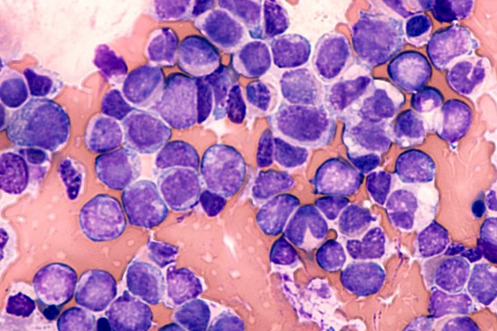 Blood cancer cells