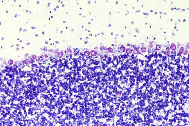 Cerebellar Ataxia - brain cells